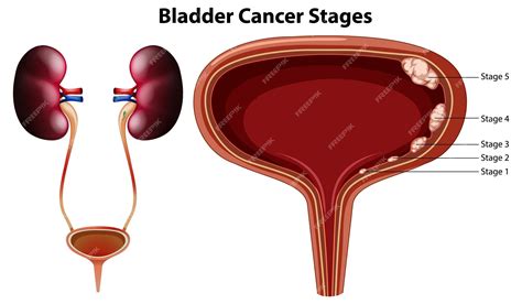 Bladder Cancer Diagram - stages of bladder cancer