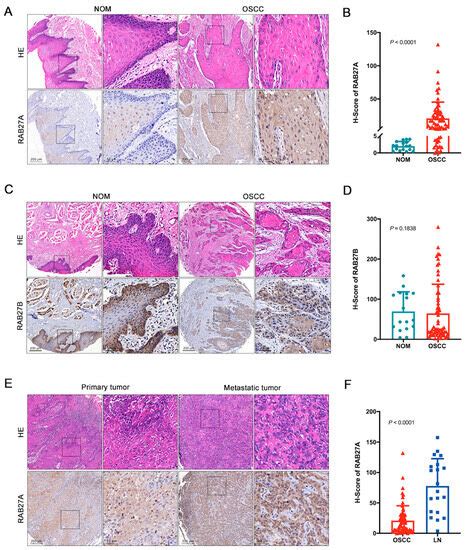 Overexpression of RAB27A in Oral Squamous Cell Carcinoma Promotes Tumor ...