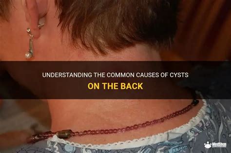 Image result for Explosive Back Cysts