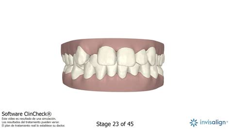 Image result for Invisalign ClinCheck