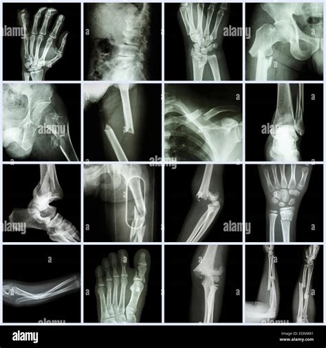 X Rays Of Broken Arm