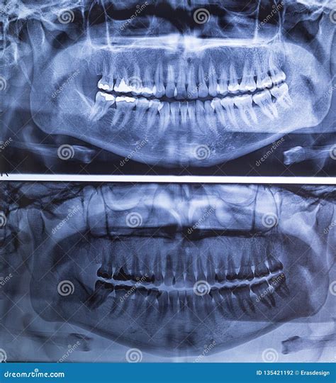 Dental X-ray of a Woman`s Teeth, Panorama 180 Degrees. X-ray with Amalgan Filling Stock Photo ...