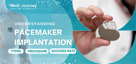 Understanding Pacemaker Implantation: Types, Procedure, and Success Rate