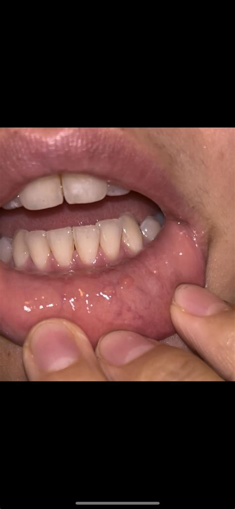 Lump inside my lip. Is this mucocele or fibroma or adenoma? : r/askdentists