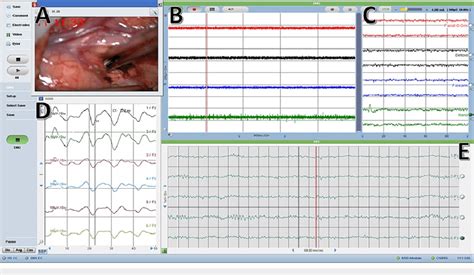 Image result for Language Mapping Awake
