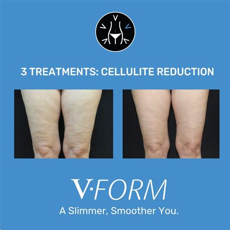 Cellulite Reduction - Aroma Spa & Laser Center