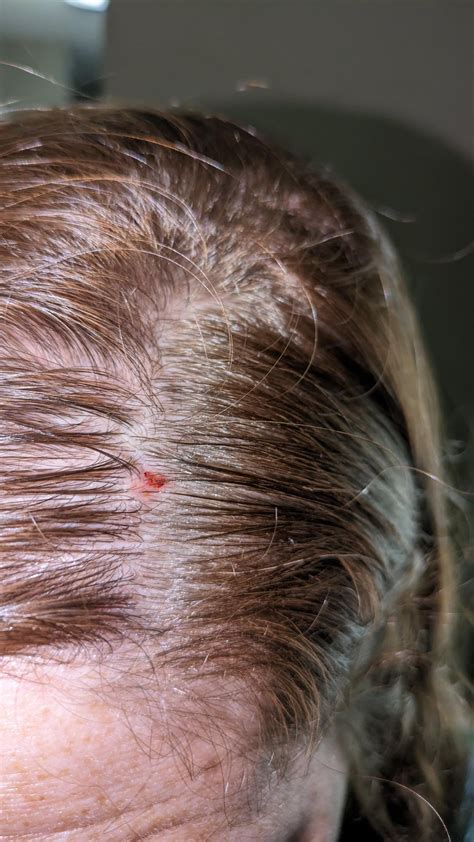 Basal cell carcinoma removed from scalp : r/MohsSurgery