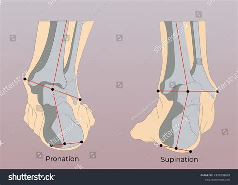 Foot Pronation