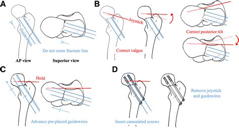 Arthroscopy-assisted Reduction and Fixation of Valgus-Impacted Femoral Neck Fractures with ...