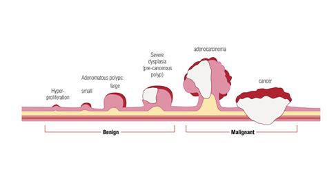 Fecal DNA Testing can Help Early Detection of Colorectal Cancer