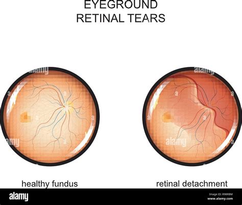 Retinal Tear Vision