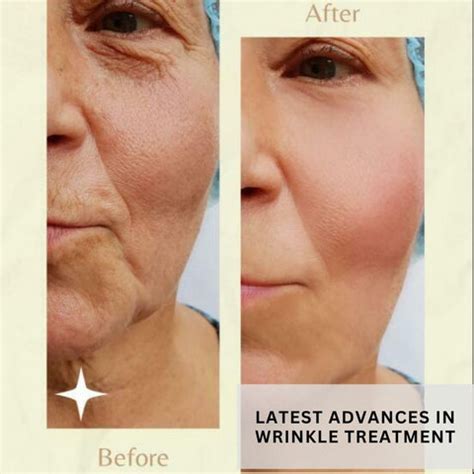 Fine Lines and Wrinkles: Causes and How to Treat | Clinikally