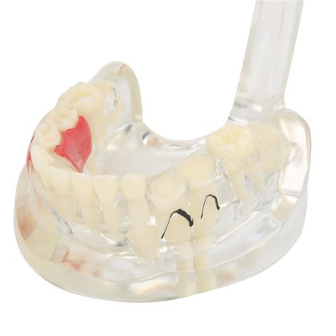 Buy Dental Teeth Models, Students' Learning Tool Teeth Pathological ...