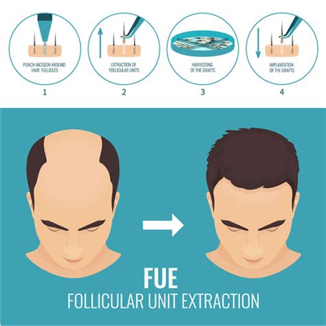 Sapphire FUE Hair Transplant Method Turkey | Dr. Ziya Yavuz