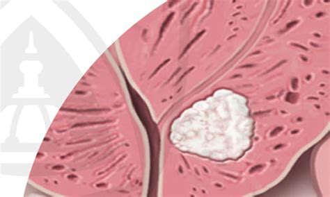 Prostate Cancer 的图像结果