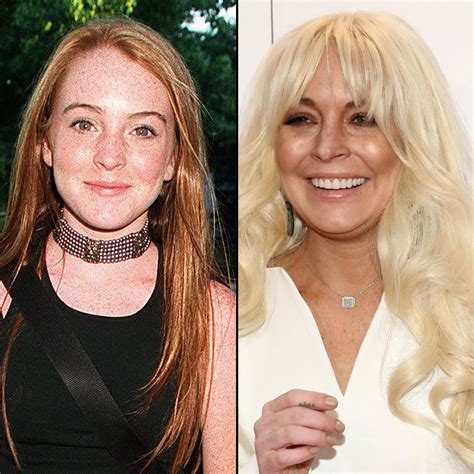 Lindsay Lohan Face Surgeries