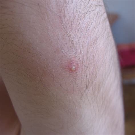 12 Causes of Itchy Legs (Including Photos and Remedies) - HubPages