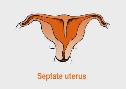 Uterine malformations in pregnancy | BabyCenter