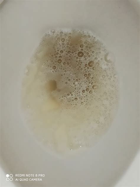 Bubbles In Urine After Catheter at Jade Stainforth blog