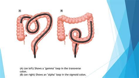 Image result for Colonoscopy Looping