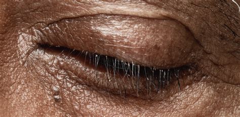 Is Blepharitis Mites