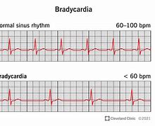 Image result for Bradycardia
