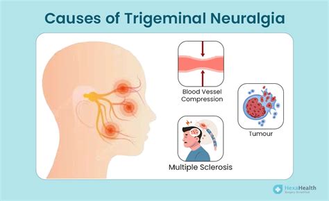Trigeminal Neuralgia - Signs, Types, Diagnosis & Treatment