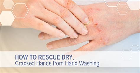 Finger Skin Cracking Causes And Treatments For Cracked Skin On Hands
