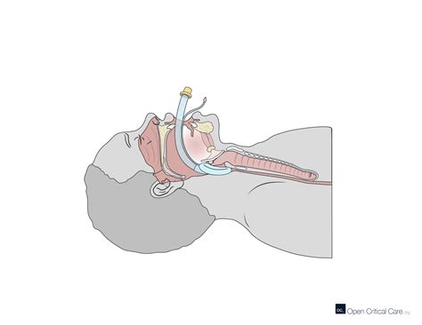 Sagittal cross section view of laryngeal mask airway - Open Critical Care