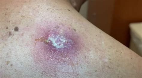 Image result for Painful Giant Abscess Exploding