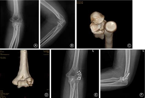 Surgical Treatment of Adams Type IV Anterolateral Fracture of the Ulna Coronoid Process - Zhang ...