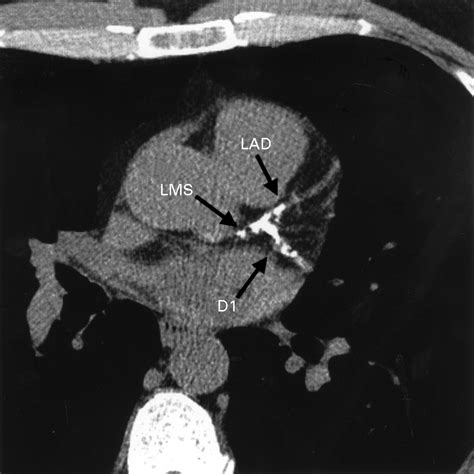 Coronary artery calcification | Heart