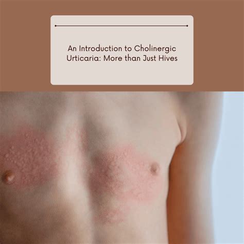 Cholinergic Urticaria: Heat-Induced Skin Reactions | Clinikally