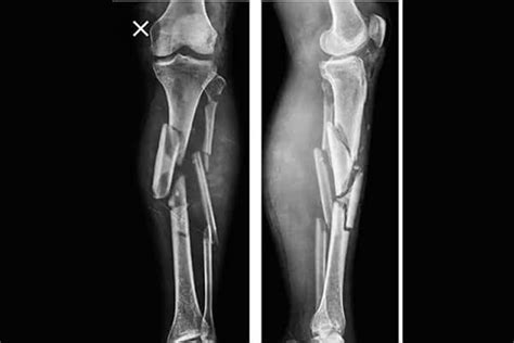 Paediatric Deformity Correctione