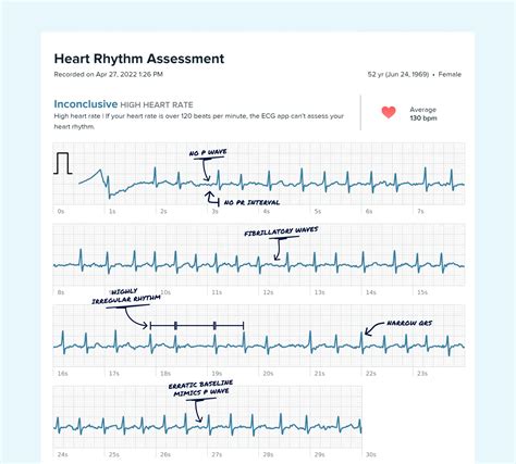 Image result for Normal vs Abnormal ECG