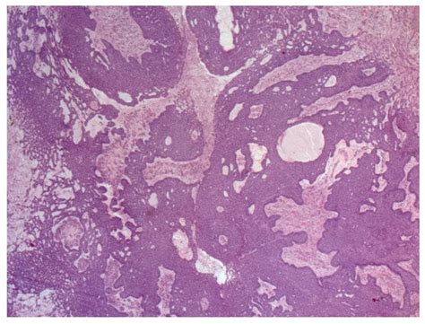 Basal Cell Carcinoma: From Pathophysiology to Novel Therapeutic Approaches