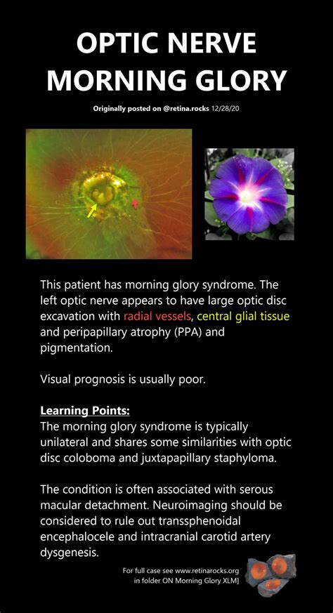 Morning Glory Syndrome Optic Nerve