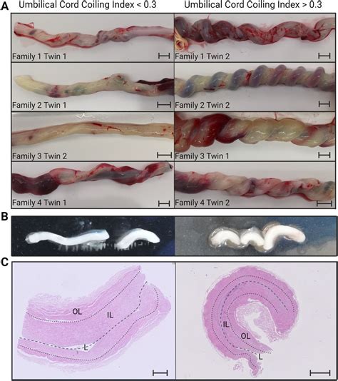 Twisting the theory on the origin of human umbilical cord coiling ...