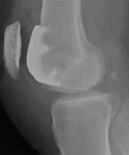 Partial Knee Replacement Surgery | DR. RAJ KANNA
