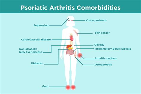Psoriatic arthritis early signs: 11 signs and symptoms to watch for