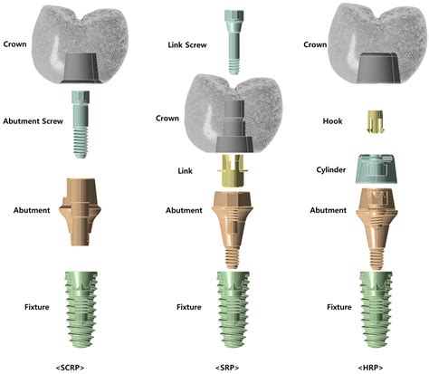 Comparative Biomechanical Evaluation of Novel Screwless Retained Dental ...