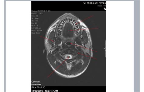 Brain CT Scan 的图像结果