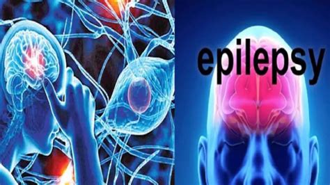 देश के 20 लाख से अधिक मिर्गी के मरीजों के लिए रामबाण साबित होगी आइआइटी ...