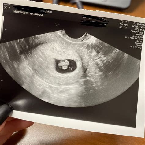 7 Week Ultrasound