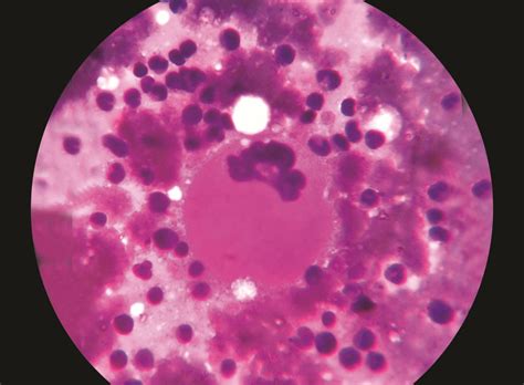 Rare and Unusual Presentation as Immune Thrombocytopenic Purpura in ...