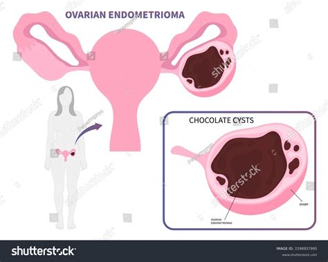 What Is A Chocolate Ovarian Cyst | How To Diagnose A Chocolate Cyst – AFVSS