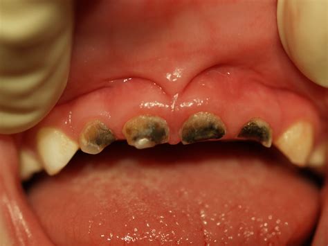 Photos Of Kids With Rotten Teeth