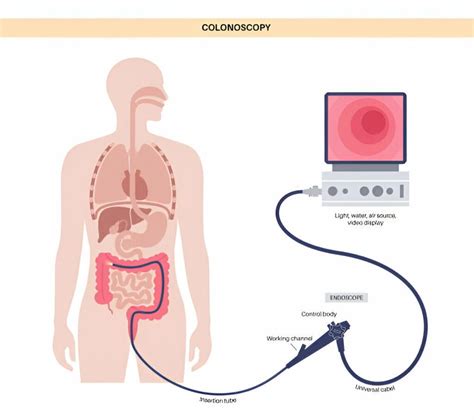 Image result for Colonoscopy Process