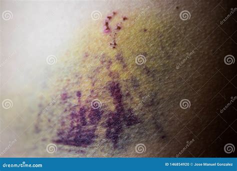 Closeup on a Bruise on Wounded Woman Stomach Skin. Purple Hurt Veins ...