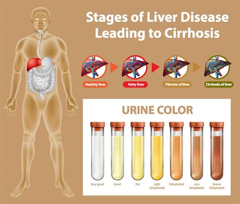 Stages of liver disease leading to Cirrhosis Stock Image | VectorGrove ...